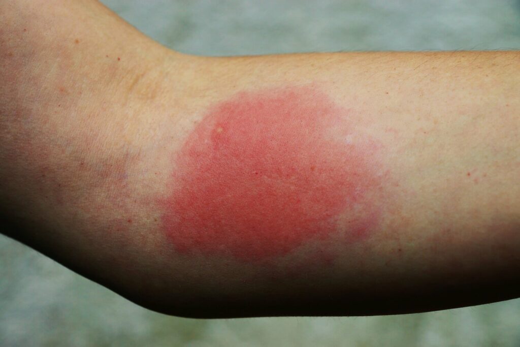 Wespenstich an Arm